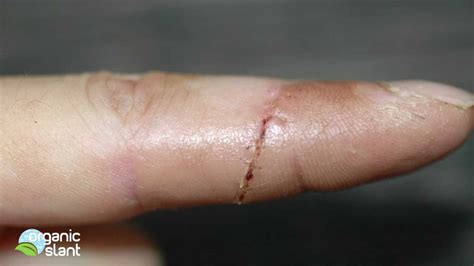 A week <b>after</b> stitchesremoved (which likely will be in 7-14 days, depending on how much tension on them). . How long does finger stay numb after stitches